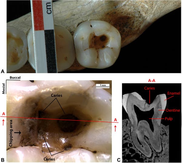 (A) Occlusal view of the RM3. (B) Detailed view of the large occlusal cavity with the four carious lesions and the chipping area on the mesial wall. Section A-A is directed mesio-distally, passing through the larger carious lesion. (C) MicroCT slice of the Villabruna RM3 in correspondence with section A-A.
Image via Nature